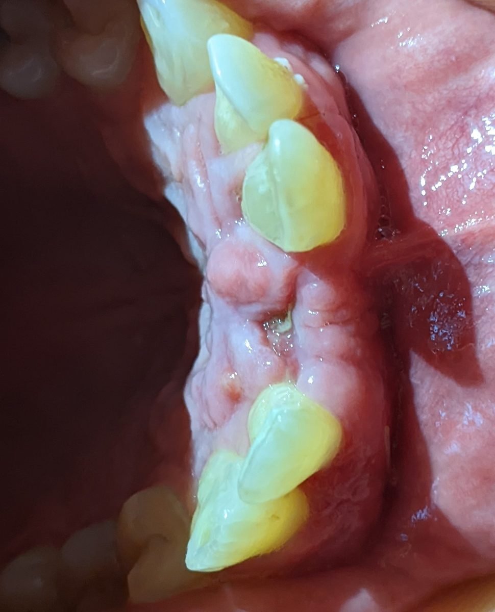 Before dental implant treatment