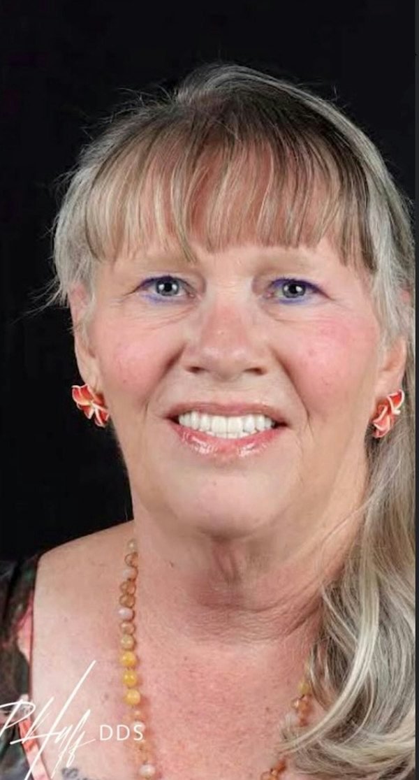 After smile makeover treatment