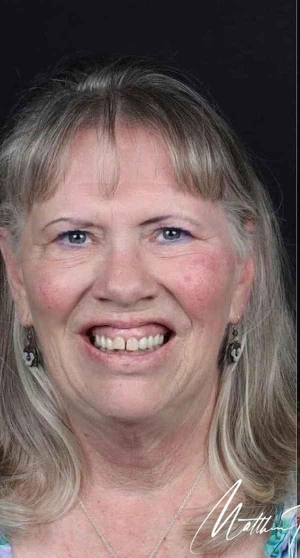Before smile makeover treatment